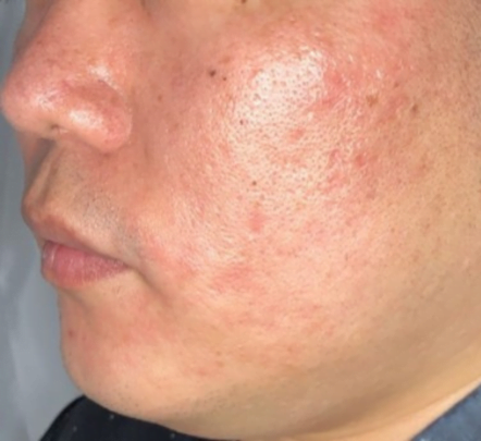 Acne/Oily skin treatment -before picture