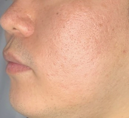 Acne/Oily skin treatment -afterpicture