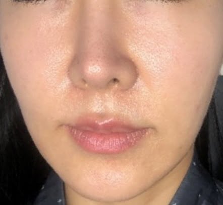 Dry/Sensitive skin treatment -after picture