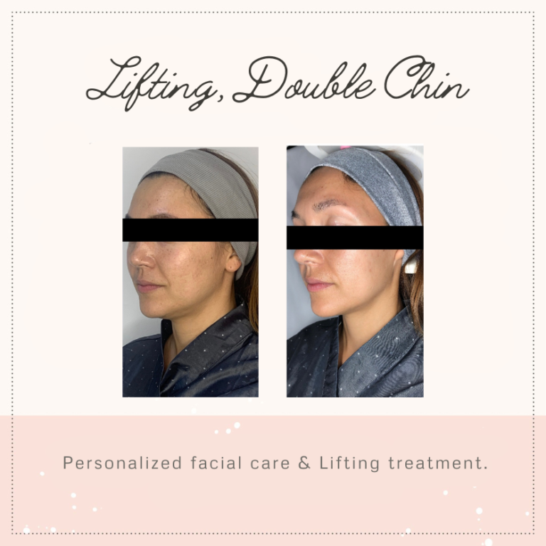before and after _doublechin,antiaging