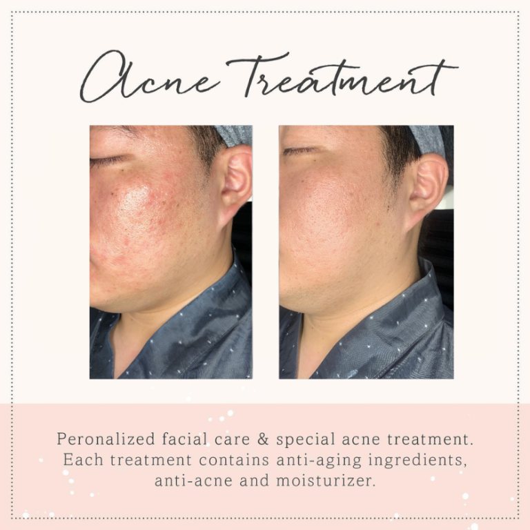 before and after_Acne,Acnescars_MTS